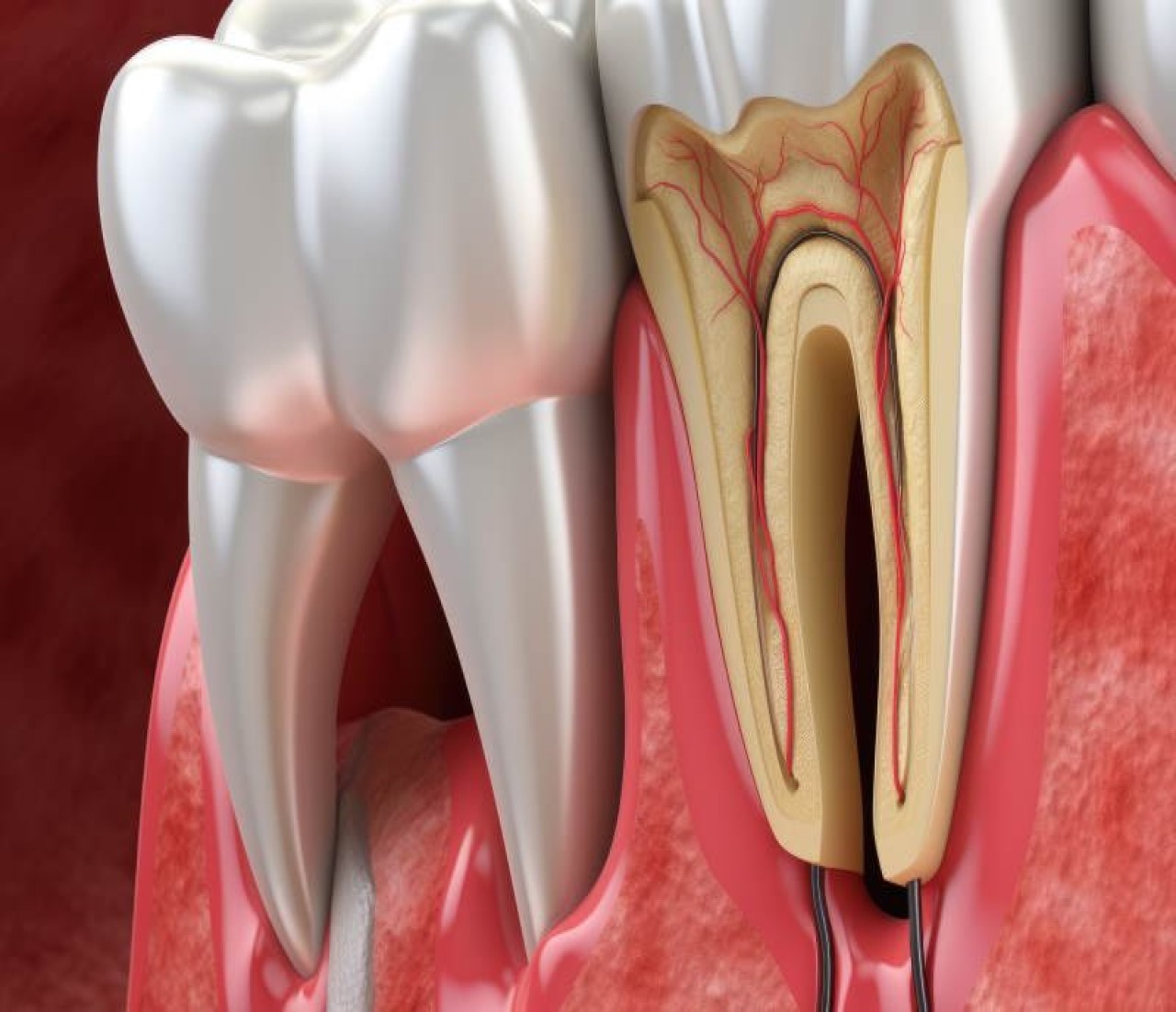 Гемисекция зуба