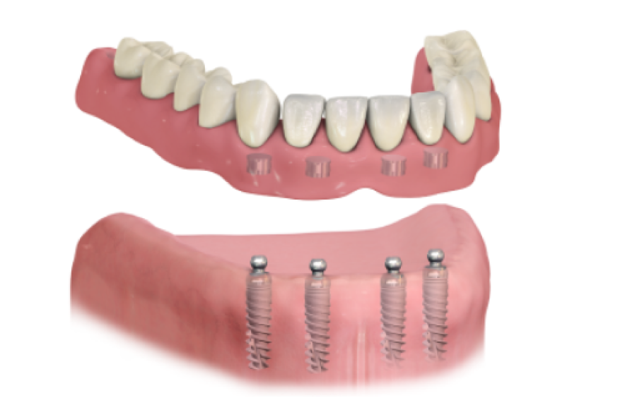 All-on-4 имплантаты